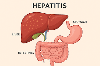 Hepatitis